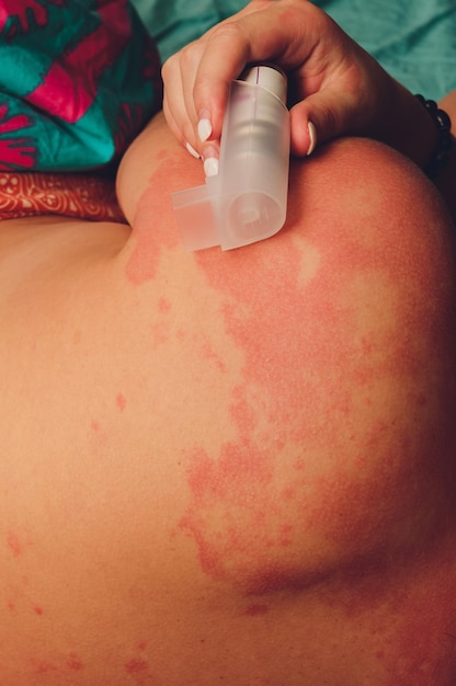 Urticaria o orticaria sulla schiena sulle spalle eruzioni cutanee rosse prurito urti