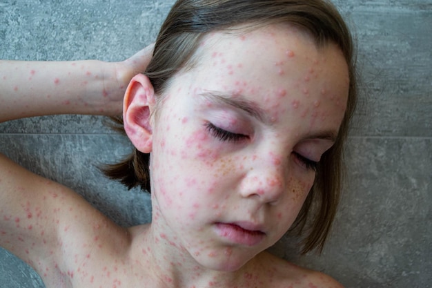 Vaccinazione naturale. Malattia contagiosa. Bambino malato di varicella. Virus della varicella o varicella b