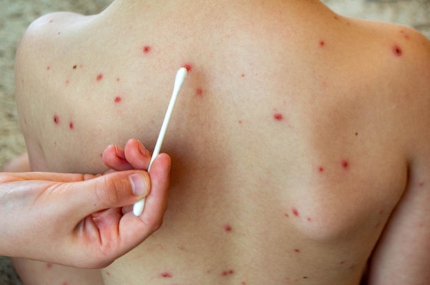 Vaccinazione naturale Malattia contagiosa