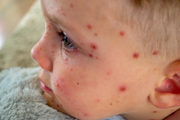 Vaccinazione naturale Malattie contagiose