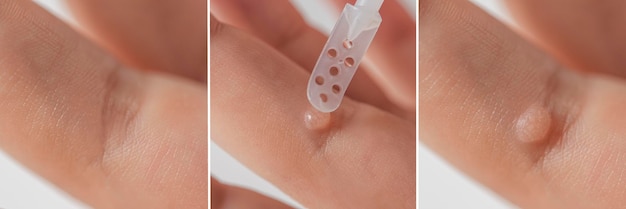 Verruca sul dito Primo piano del trattamento della verruca prima e dopo Applicare il medicinale sulla verruca Papillomavirus umano HPV copia spazio