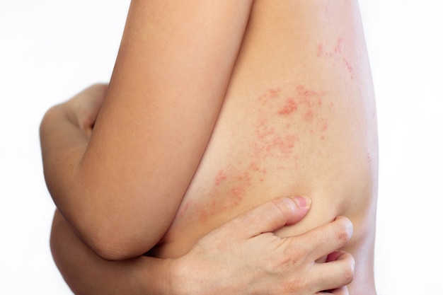 Vesciche causate da herpes zoster sul corpo della giovane donna Prurito e arrossamento sulla schiena delle ragazze