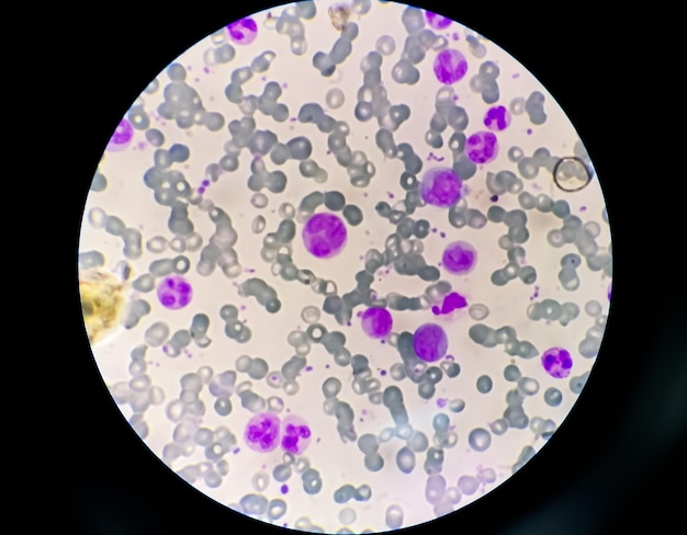 Vista al microscopio 40x della leucemia mielocitica cronica o LMC