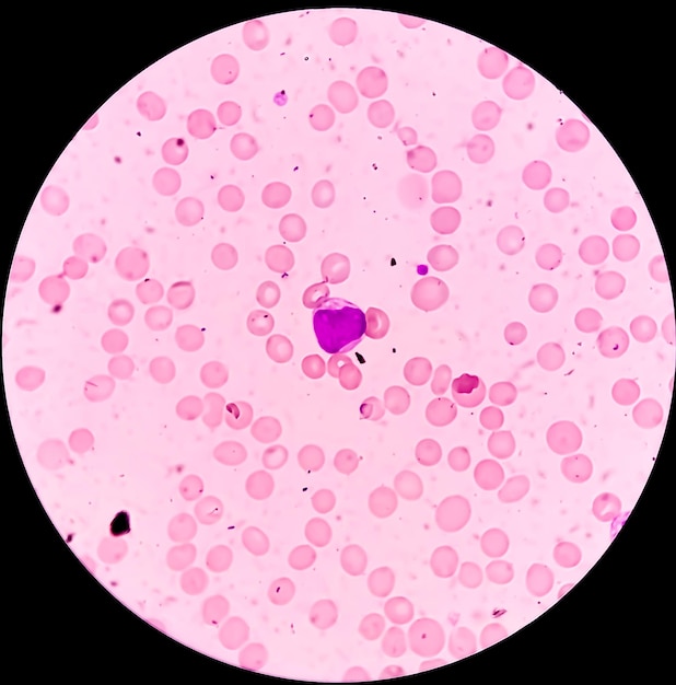 Vista al microscopio di leucemia mieloide acuta o AML