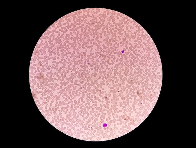 Vista al microscopio di trombocitopenia o piastrine basse