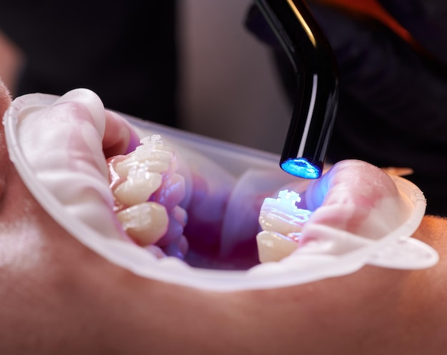 Vista in primo piano della mano del dentista nel guanto nero utilizzando la lampada UV per l'indurimento dentale sui denti del paziente Divaricatore della guancia sulle labbra Vista laterale Concetto di procedure dentali