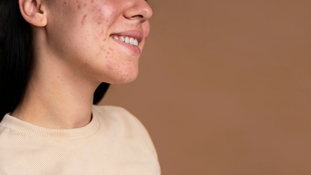 Vista laterale giovane donna con acne