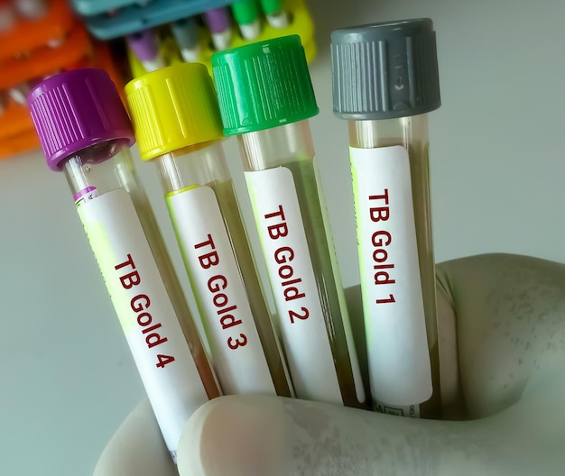 Vista ravvicinata dei campioni di sangue della presa della mano dello scienziato per il test TB Gold o Quantiferon