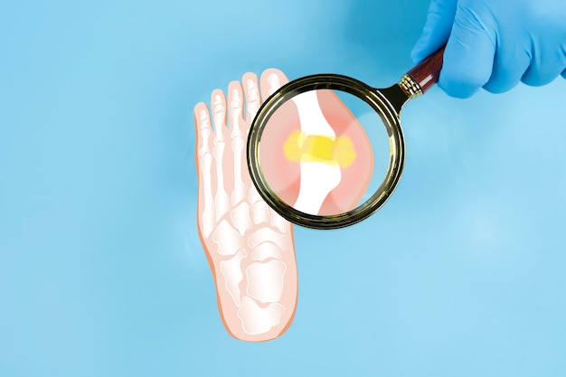visto attraverso una lente di ingrandimento isolato in cima illustrazione medica per l'istruzione concetto di gotta