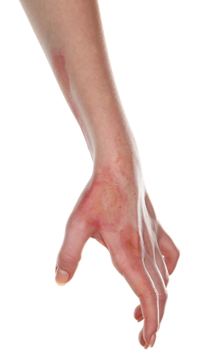 Fotografie horrible burns on female hand isolated on white