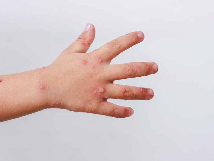 Fotografie red rash on baby hands hand-foot-and-mouth disease hfmd enterovirus coxsackie virus infection