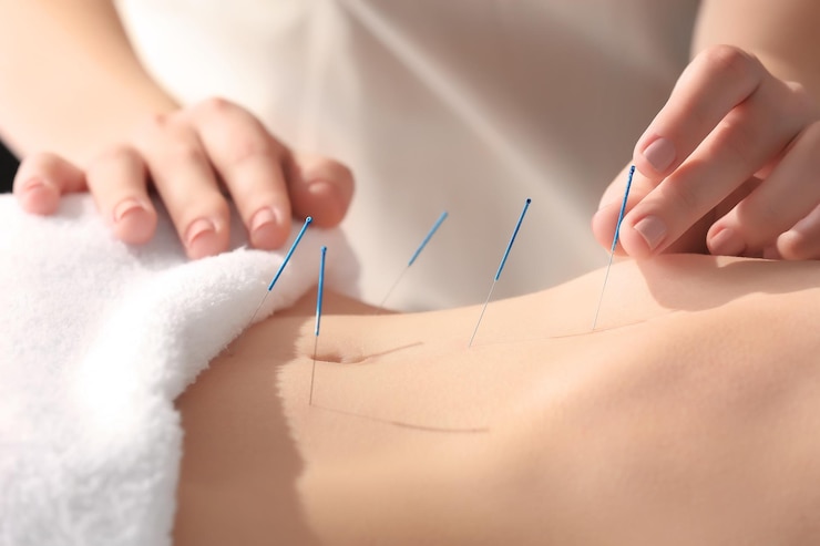 Fotografie young woman undergoing acupuncture treatment closeup
