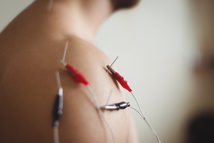 Zdarma Fotografie close-up of patient getting electro dry needling