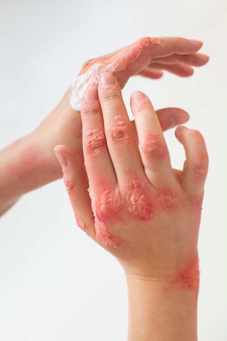 Zdarma Fotografie hands of patient suffering from psoriasis