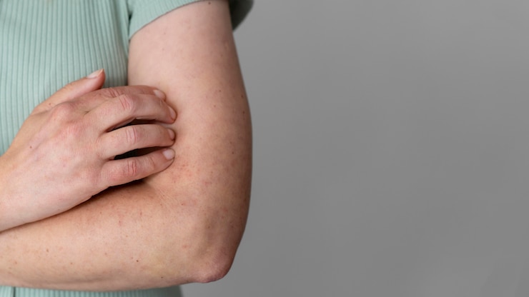Foto grátis alergia cutânea no braço da pessoa com espaço de cópia
