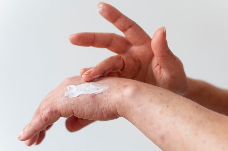 Foto grátis alergia cutânea no braço de uma pessoa