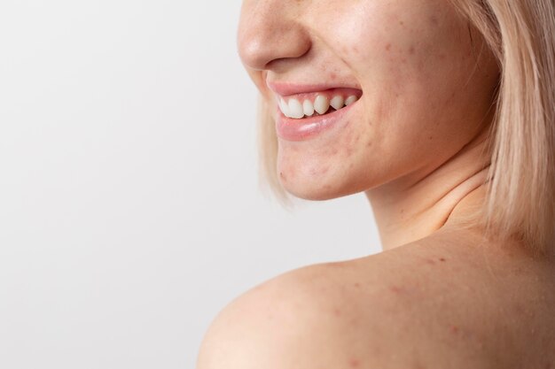 Close-up de modelo sorridente com acne