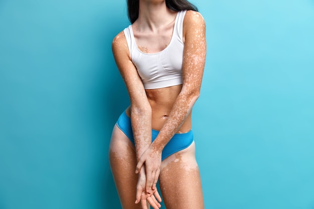 Close-up em mulher magra com pele vitiligo