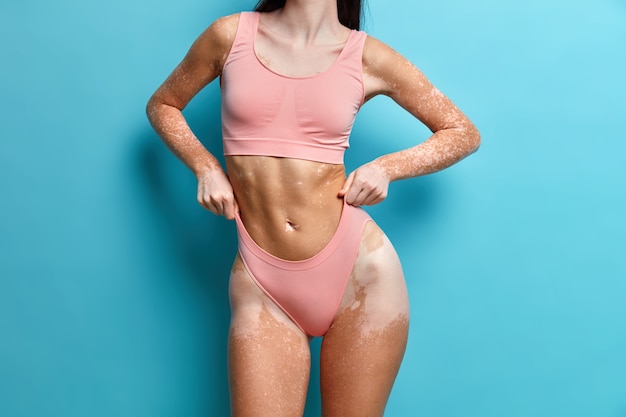 Foto grátis close-up em mulher magra com pele vitiligo