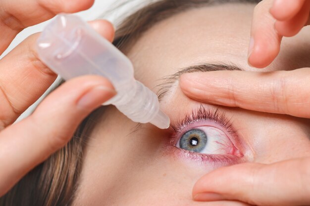 Close-up feminino derrama gotas nos olhos vermelhos, tem conjuntivite ou glaucoma, visão ruim e dor. Olhos dor conceito de tratamento. Mulher cura olho vermelho sangue