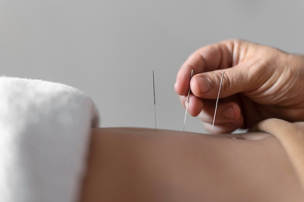Close-up mão segurando agulha de acupuntura