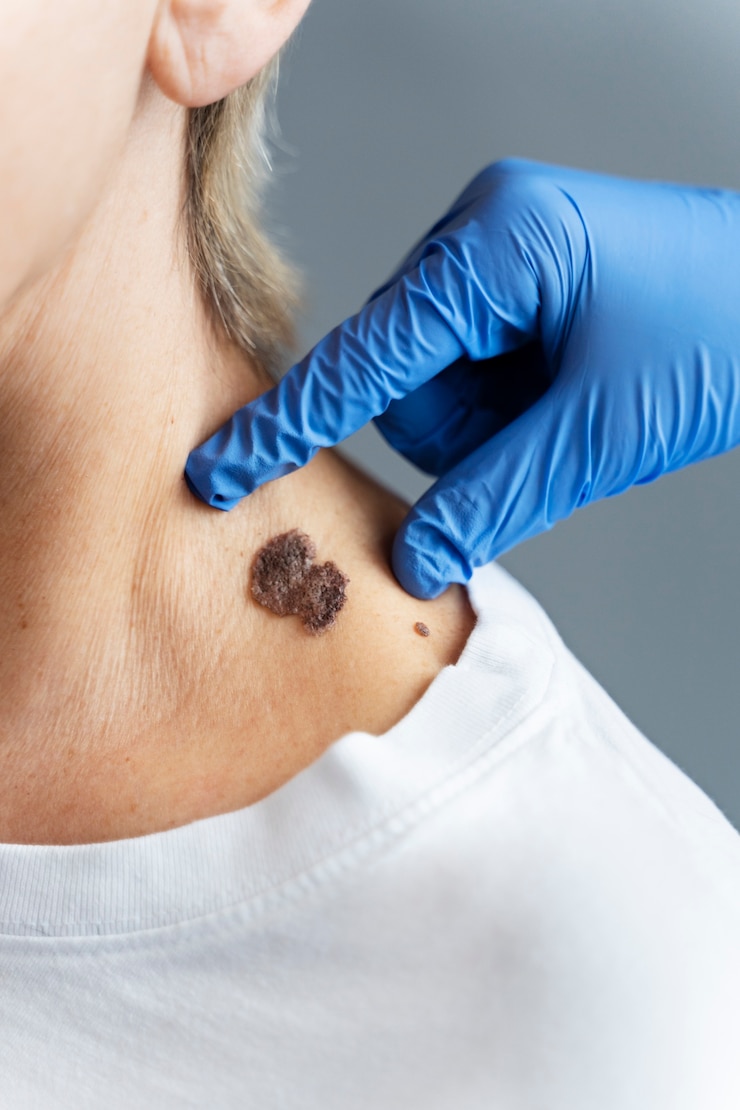 Foto grátis fechar a mão tocando a pele com melanoma