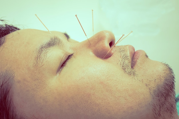 Foto de estilo vintage de homem asiático está recebendo tratamento de acupuntura