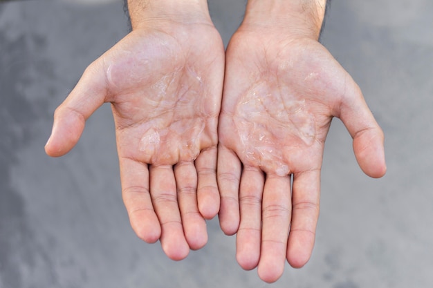 Homem usando gel hidroalcoólico