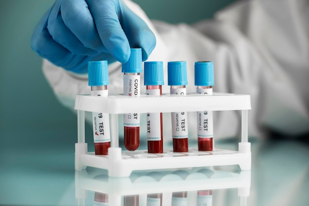Mão com luvas de proteção segurando amostras de sangue para teste ambíguo