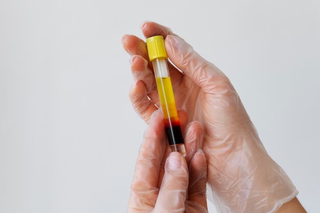 Mãos segurando o frasco para tratamentos prp close-up