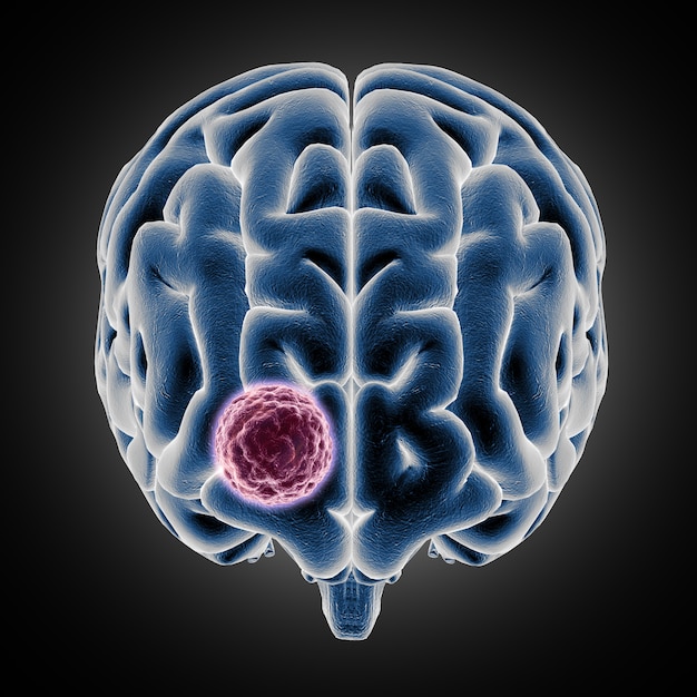 Médico 3D mostrando o cérebro com tumor crescendo