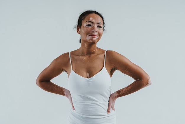 Mulher bonita com pele vitiligo, posando no estúdio. conceito sobre positividade corporal e autoaceitação