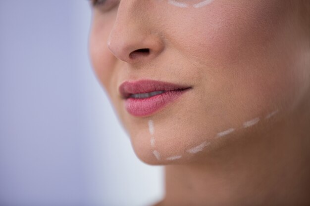 Mulher com marcas desenhadas para tratamento cosmético na mandíbula