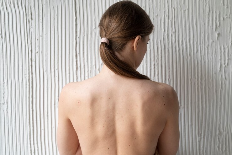 Foto grátis mulher com melanoma na pele