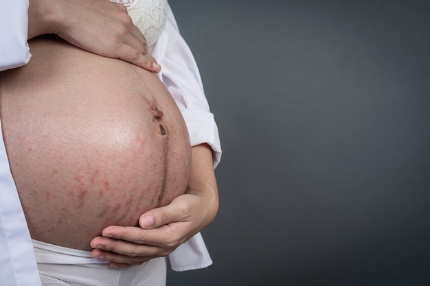 Mulher gravida com barriga listrada.