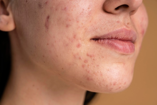 Mulher jovem confiante com um close de acne
