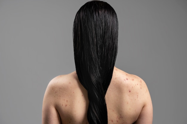 Foto grátis mulher jovem mostrando acne nos ombros