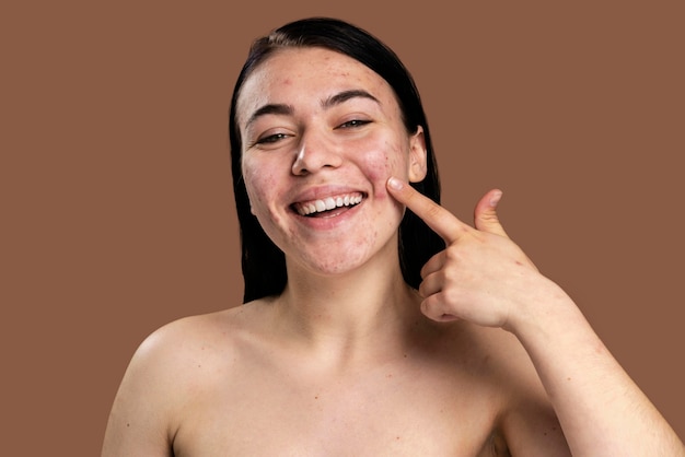 Mulher sorridente mostrando sua acne com confiança