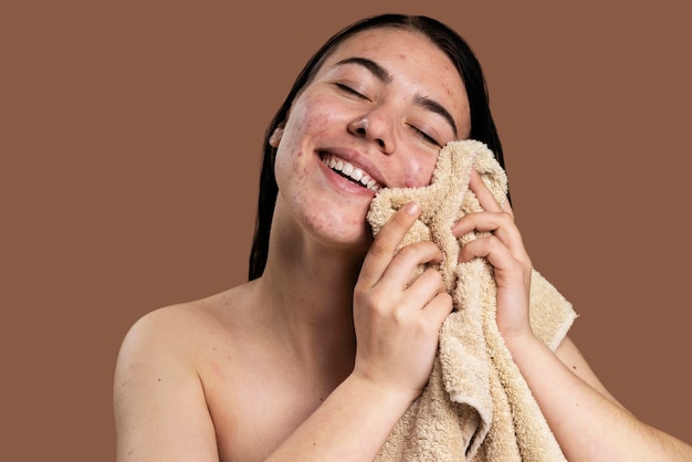 Mulher sorridente mostrando sua acne com confiança