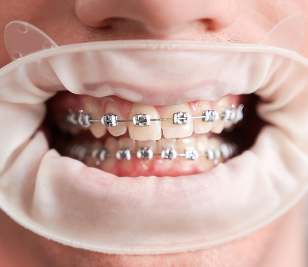 Paciente do sexo masculino com ensecadeira na boca mostrando os dentes com aparelho