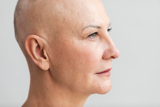 Retrato de mulher com câncer de pele