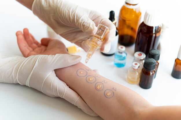 Teste de reação alérgica cutânea no braço de uma pessoa