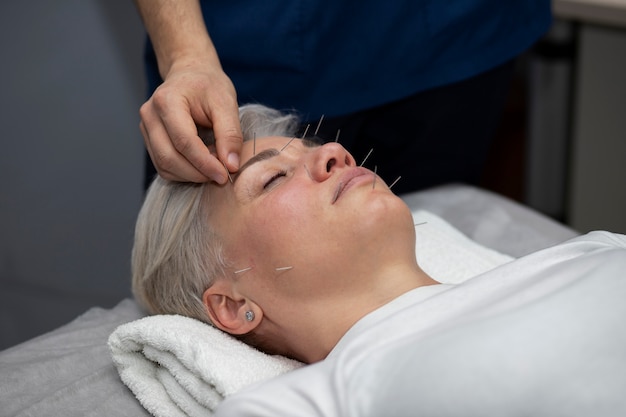 Foto grátis tratamento de acupuntura de mulher de alto ângulo