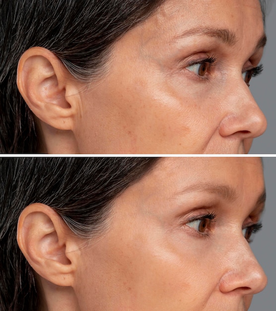 Tratamento de beleza anti-envelhecimento