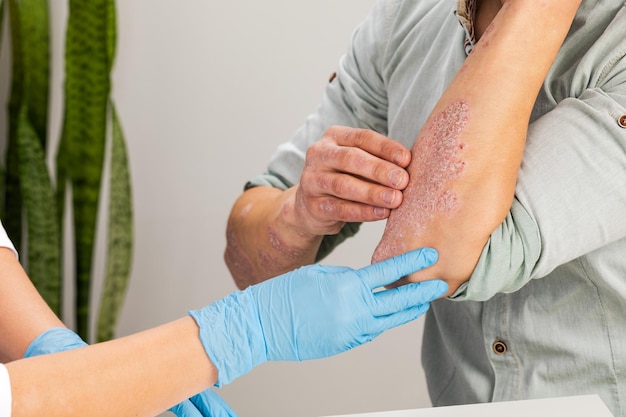 Um dermatologista usando luvas examina a pele de um paciente doente. exame e diagnóstico de doenças de pele-alergias, psoríase, eczema, dermatite.