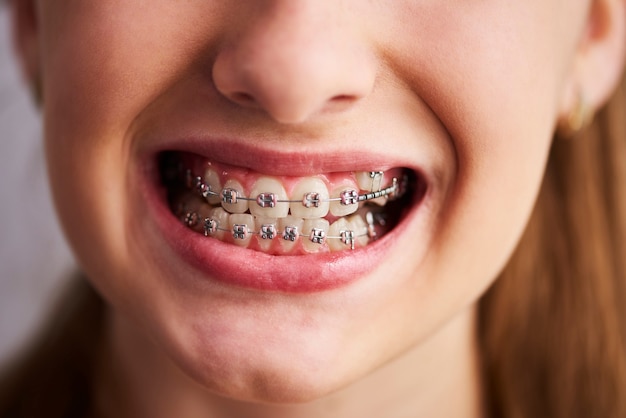 Aufnahme von Zähnen mit Zahnspange