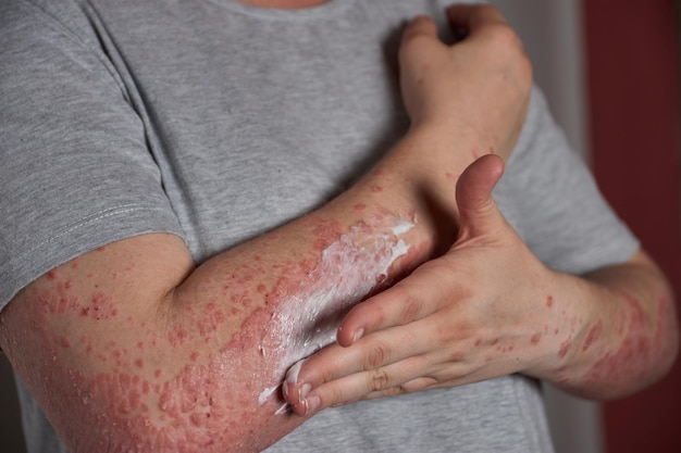 Auftragen von Feuchtigkeitscreme auf Haut mit Psoriasis