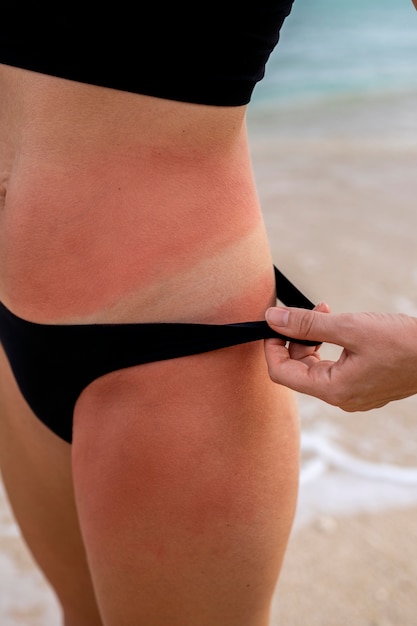 Blick auf die sonnenverbrannte Haut einer Frau vom Tragen eines Bikinis