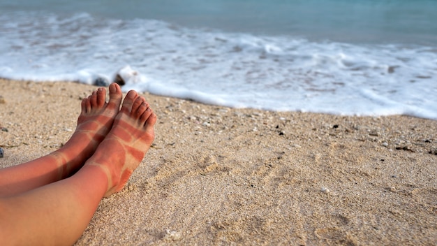 Blick auf die sonnenverbrannten Füße einer Frau vom Tragen von Sandalen am Strand