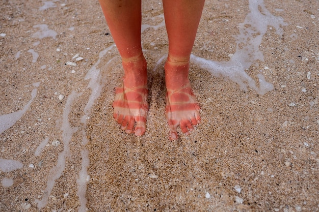 Blick auf die sonnenverbrannten Füße einer Frau vom Tragen von Sandalen am Strand